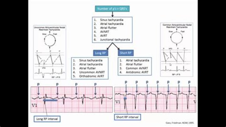 Is SVT wide or narrow complex