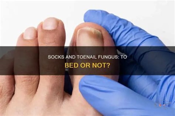 Should I wear socks to bed with toenail fungus?