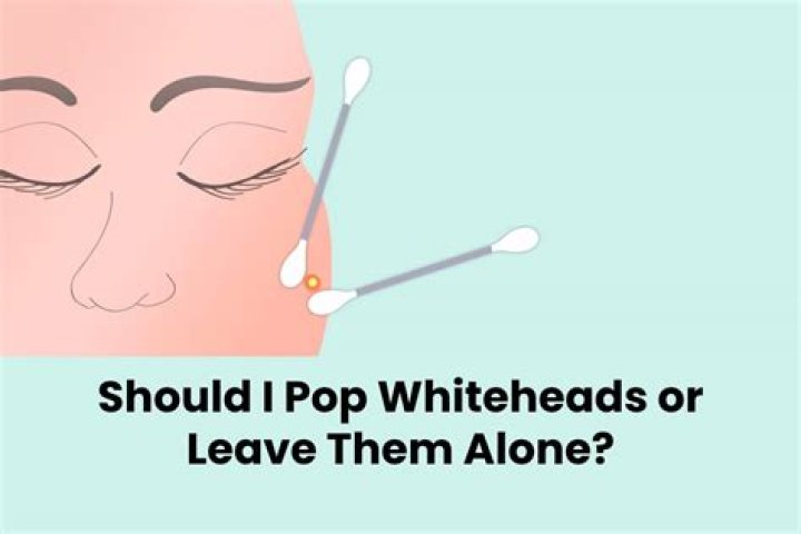Should you pop Whiteheads?