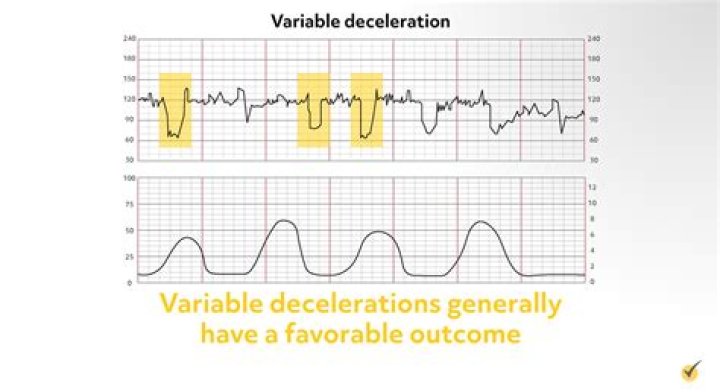 What are early Decels