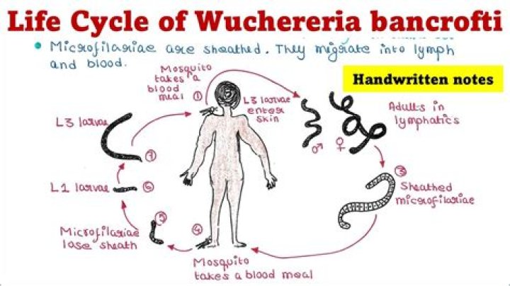 What are the symptoms of wuchereria Bancrofti