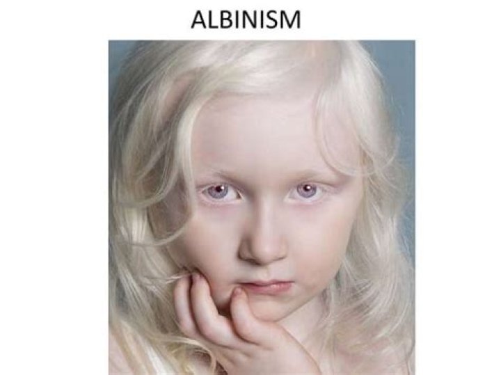 What are the types of albinism?
