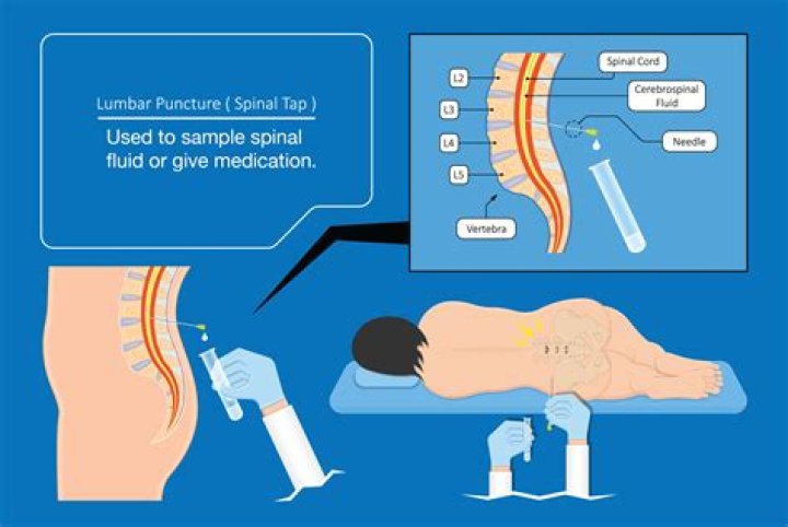 What can I expect after a lumbar puncture?