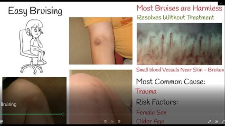 What can I take to stop bruising easily?