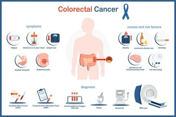 What causes colon cancer? | ContextResponse.com