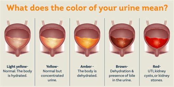 What causes dark urine and pale stools?