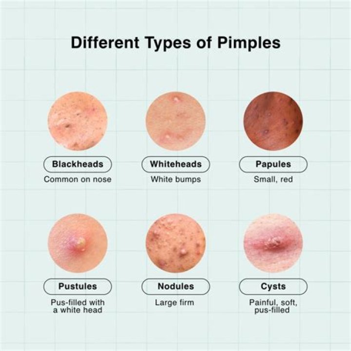 What causes earlobe pimples?