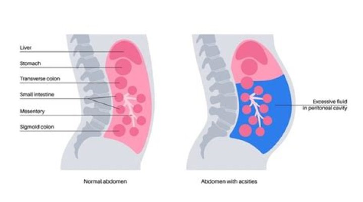What causes increased abdominal girth