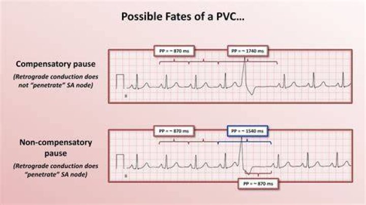 What causes PACs and PVCs?
