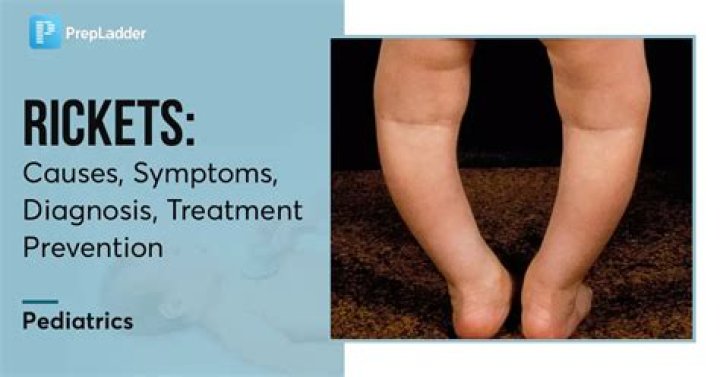 What causes rickets?