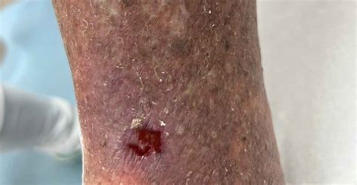What does a venous stasis ulcer look like