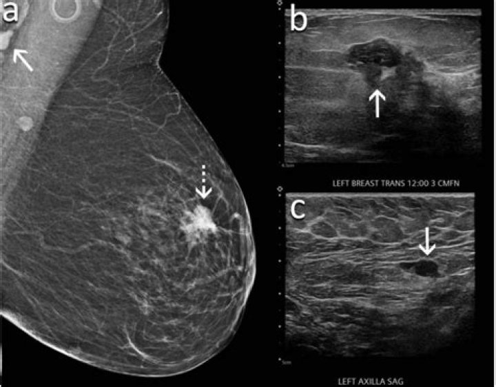 What does breast cancer look like?