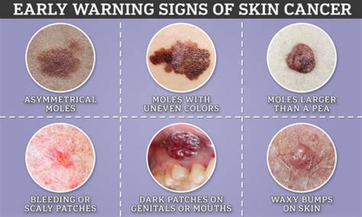 What does cancerous mole look like?
