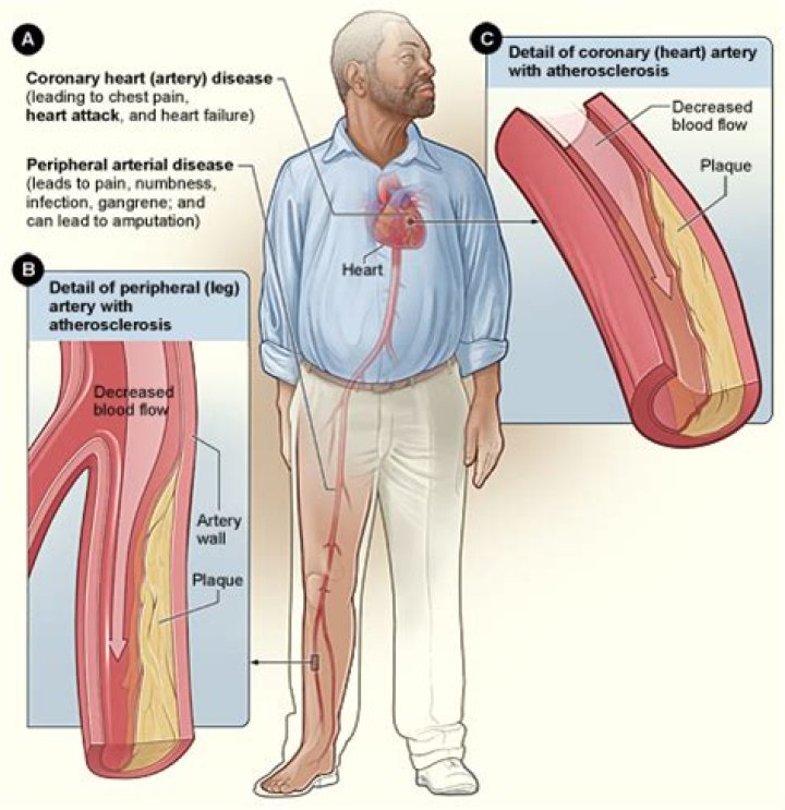 What does coronary arteriosclerosis in native artery mean