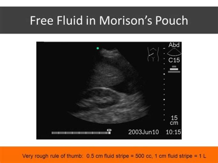 What does fluid in Morison's pouch mean?