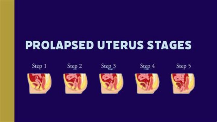 What does it mean if your uterus has dropped?