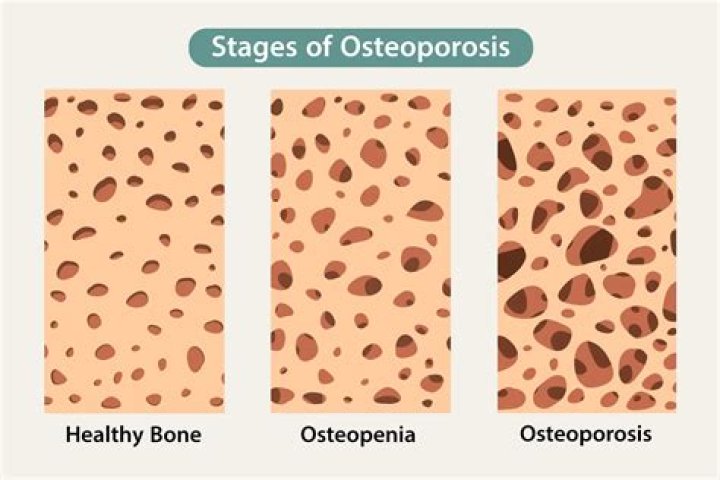 What does it mean to have osteopenia?