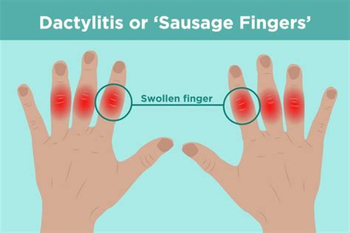 What does it mean when your finger is swollen and stiff?