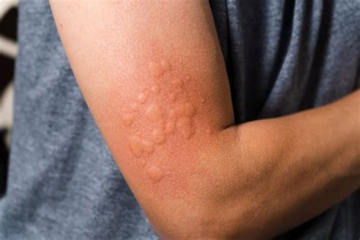 What does latex allergy look like?