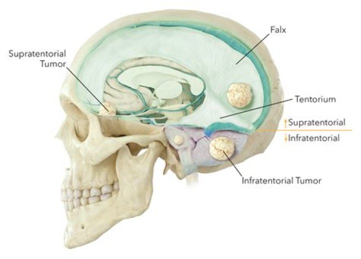 What does lesions on the skull mean