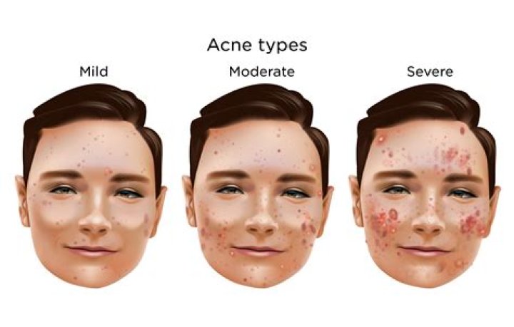 What does moderate allergy mean?
