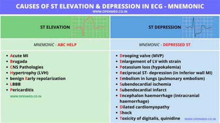 What does ST depression on ECG mean?
