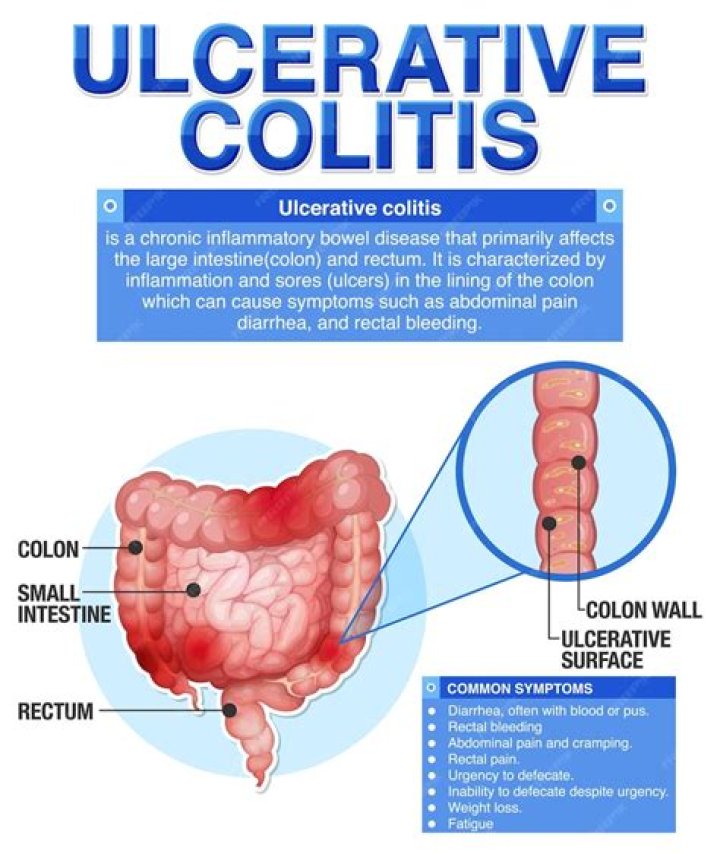 What does ulcerative colitis look like on endoscopy?