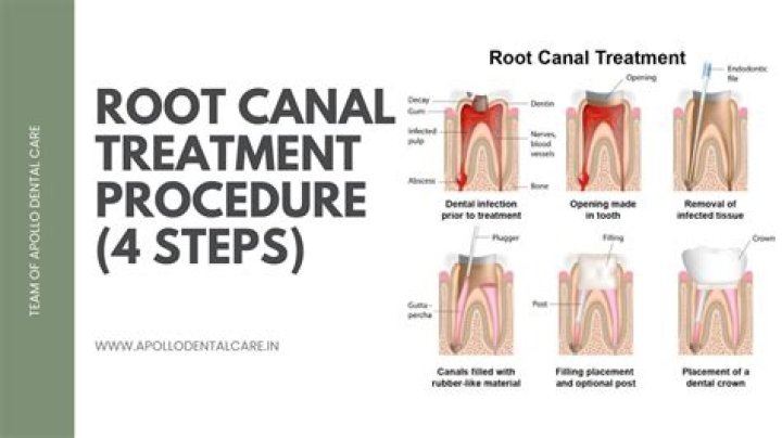 What happens if you don't get a root canal?