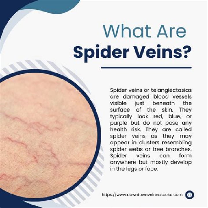 What hormones cause spider veins?
