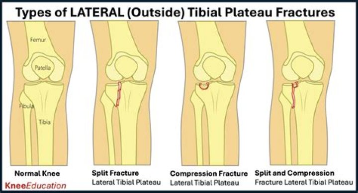 What is a lateral tibial plateau fracture
