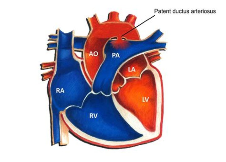 What is a PDA heart defect