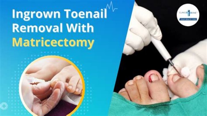 What is a phenol Matricectomy?