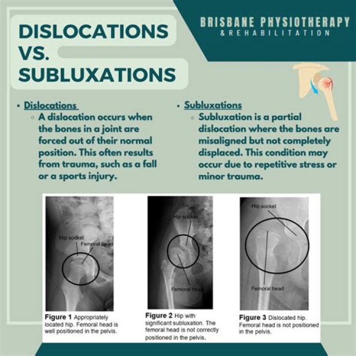 What is a subluxation diagnosis?