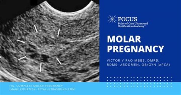 What is an incomplete molar pregnancy?