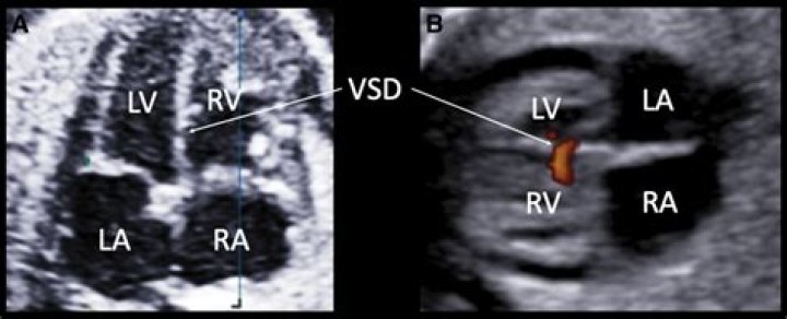 What is an intraventricular cyst?