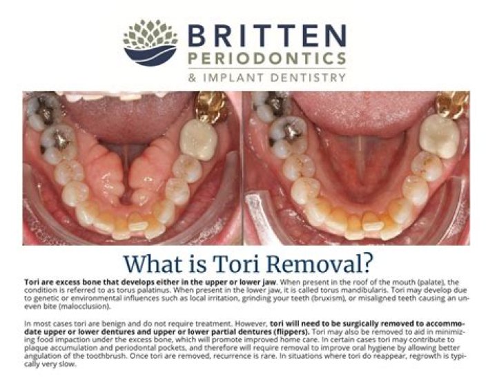 What is dental Tori? | ContextResponse.com