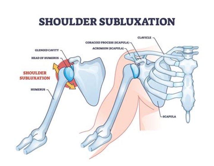 What is dorsal subluxation of the distal ulna?