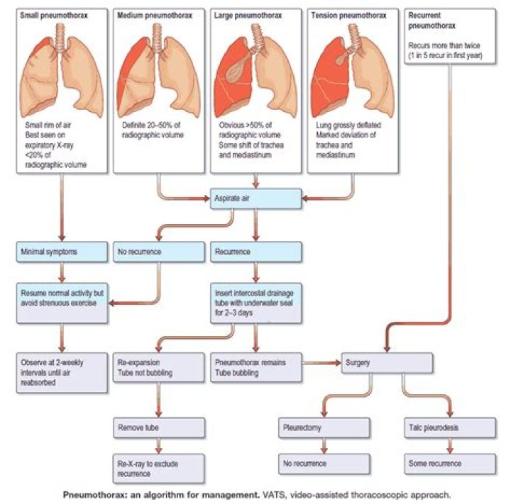 What is Iatrogenic pneumothorax? | ContextResponse.com