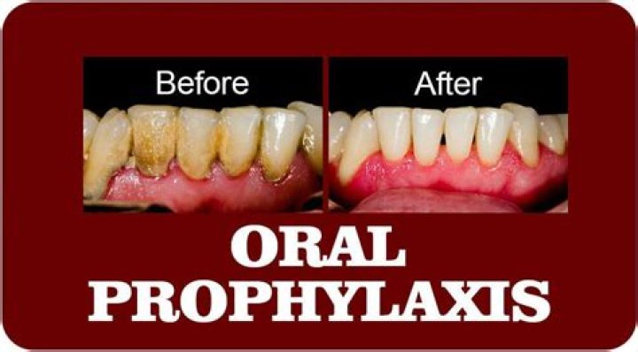 What is oral prophylaxis treatment
