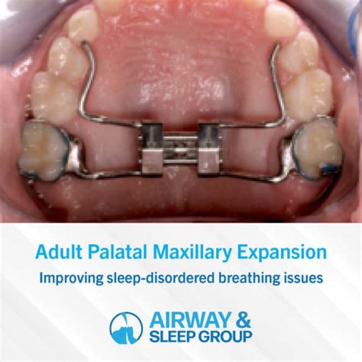 What is palatal palsy