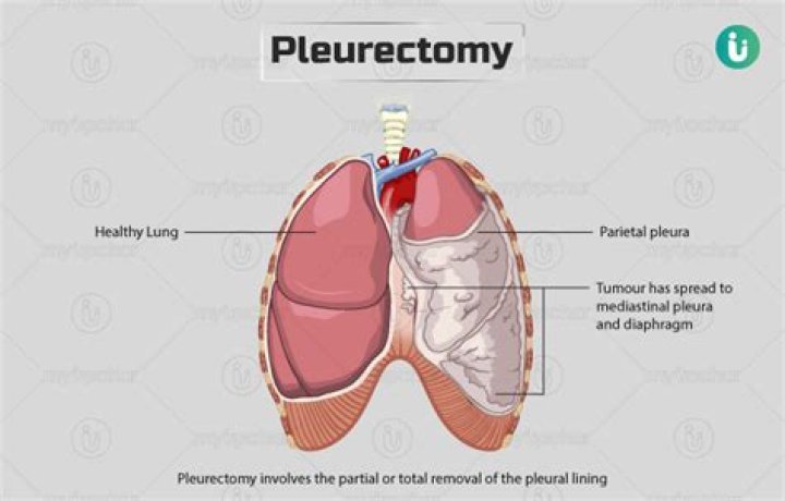 What is Pleurectomy and Decortication?