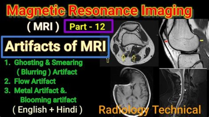 What is pulsation artifact on MRI