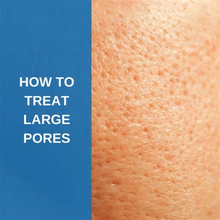 What is the best treatment for big pores?