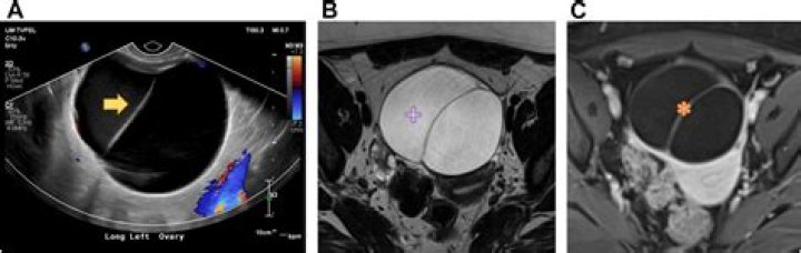 What is the diagnosis code for adnexal cyst?