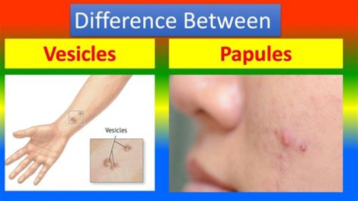 What is the difference between a vesicle and a pustule