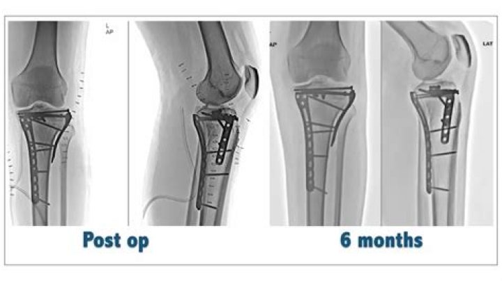 What is the ICD 10 code for tibial plateau fracture