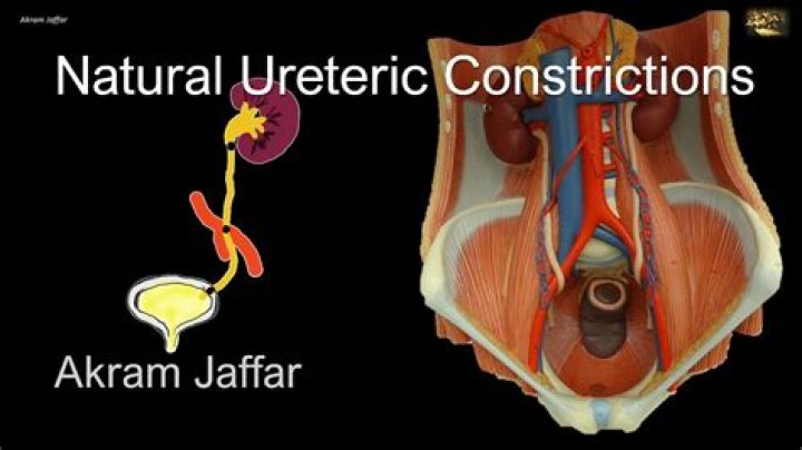 What is the medical term for abnormal narrowing of the ureter?