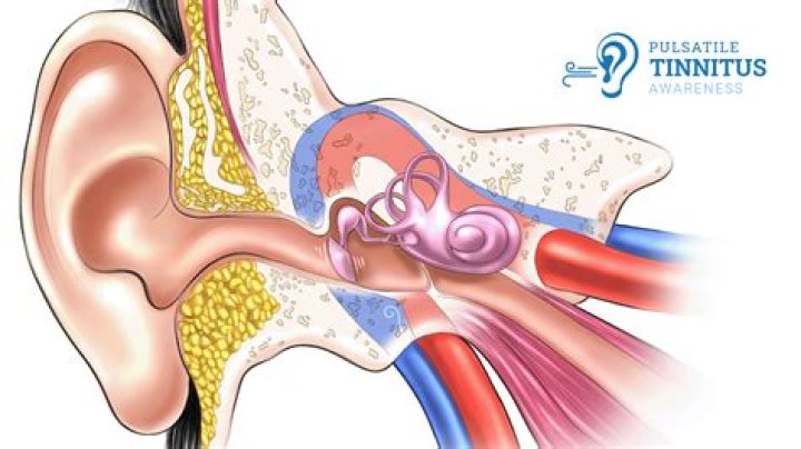 What is the most common cause of pulsatile tinnitus?