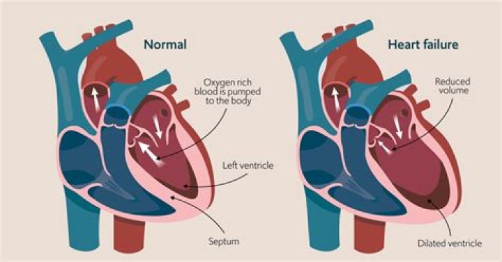 What is the most common cause of systolic heart failure