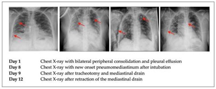 What is the treatment for Pneumomediastinum?